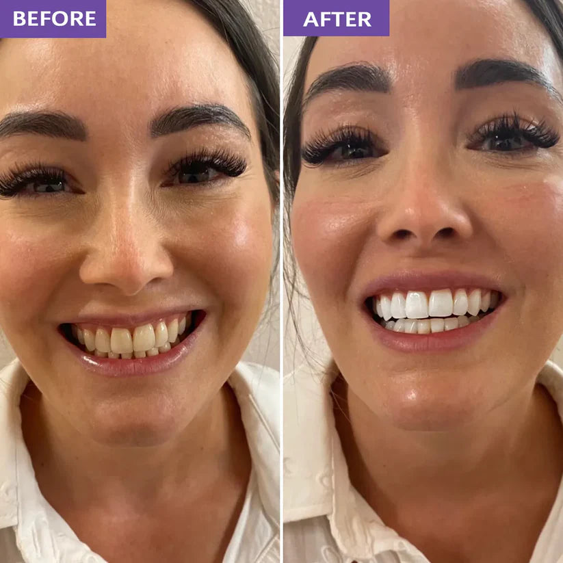 Purple Whitening Strips