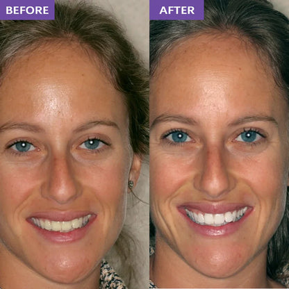 Purple Whitening Strips